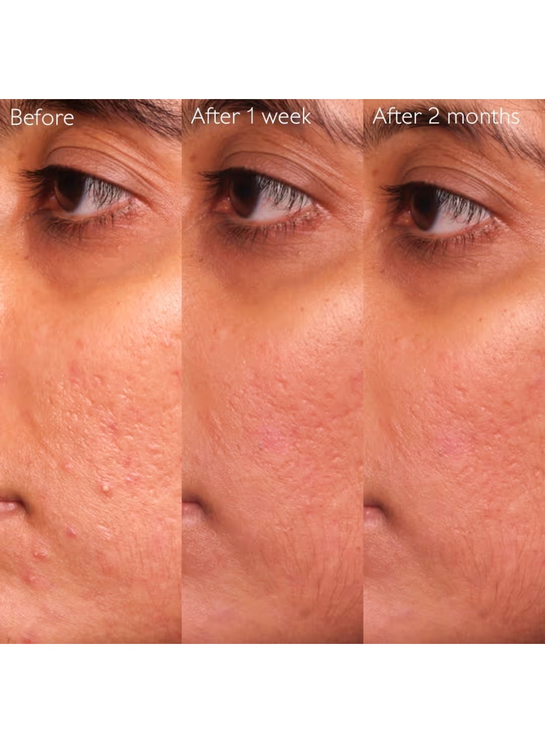 Vinopure Blemish Control Salicylic Serum - 30 mL - image 5
