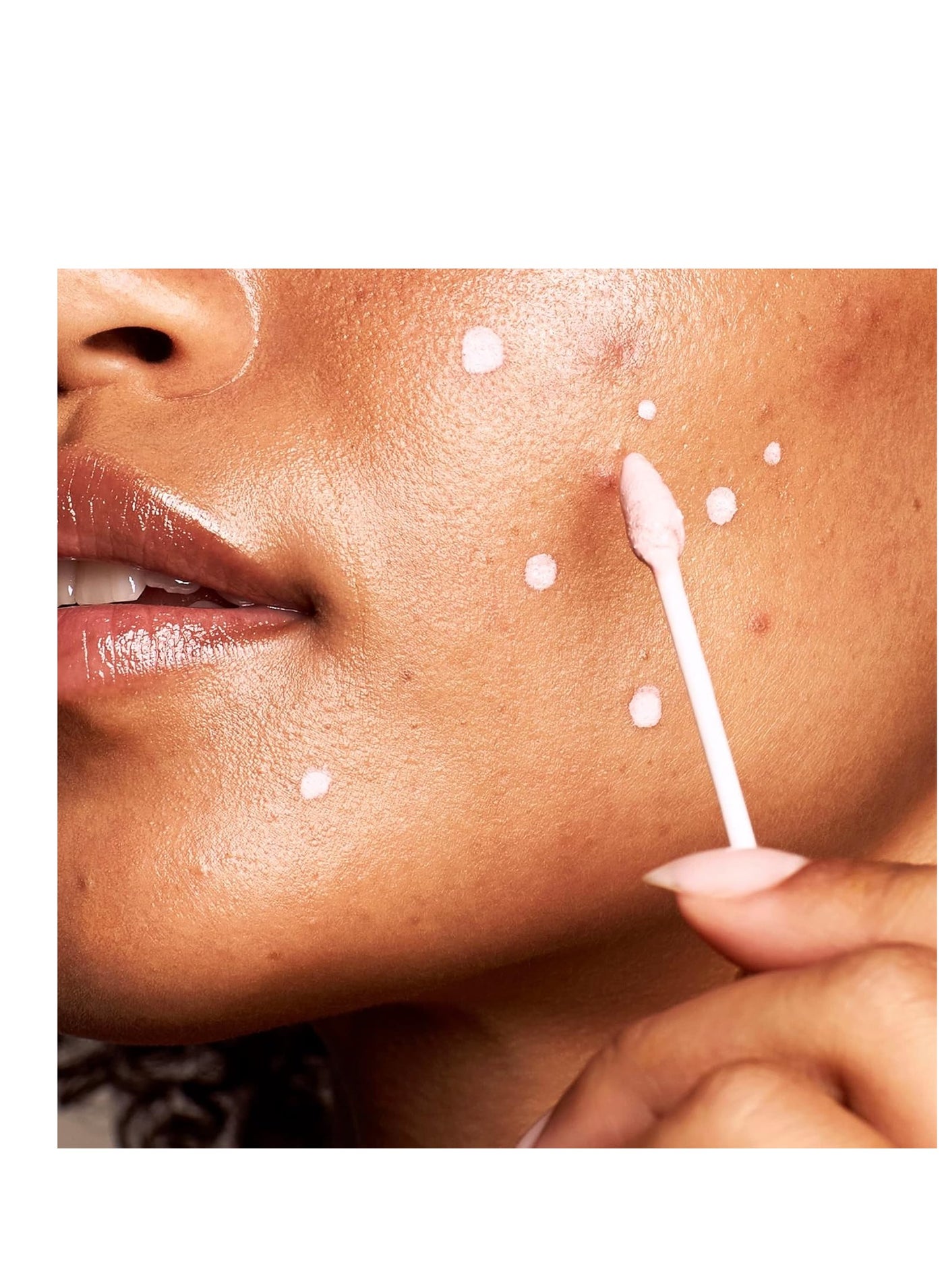 Kate Somerville EradiKate Acne Treatment - Clinically Formulated 10% Sulfur and BHA Spot Treatment â€“ Clears Pimples, Cleans Pores and Prevents Breakouts, 1 Fl Oz