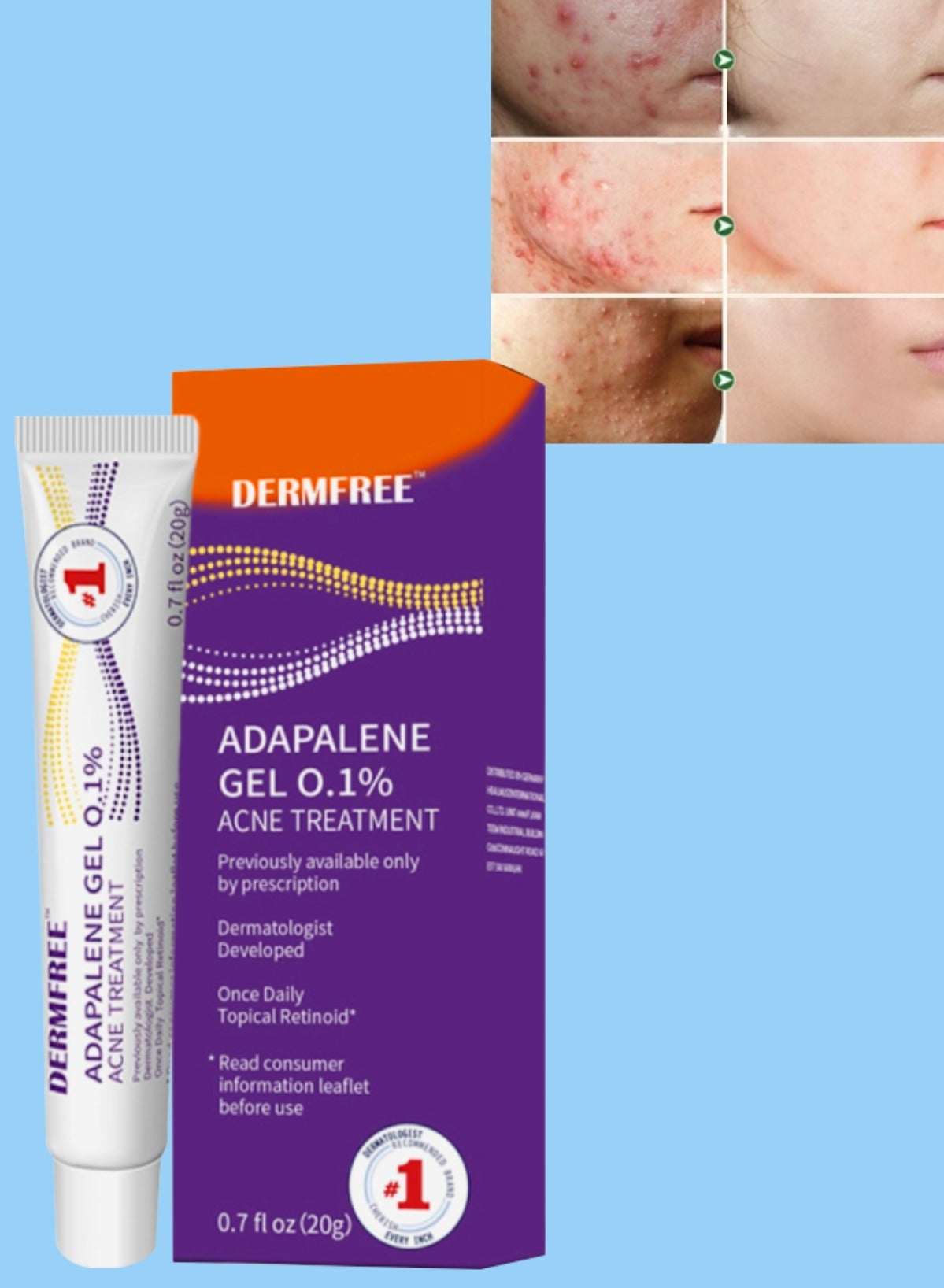 Adapalene Gel Acne Treatment Acne Treatment Cream Acne Treatment Ointment Gel Acne Relief Cream Gentle Moisturizing Acne Removing Gel Pimple and Acne Removal Anti Acne Gel 20g