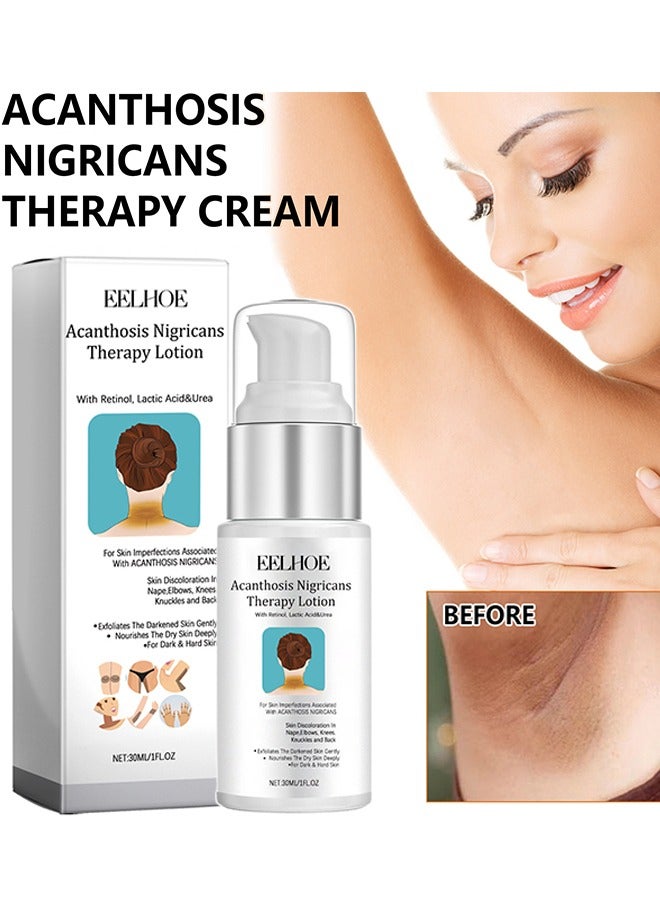Acanthosis Nigricans Therapy Lotion - with Lactic Acid ,Dermatologist Tested Retinol Lotion, Hyperpigmentation Removal Lotion, For Dark Body Parts like Neck Ankles Knuckles Armpits 30ml