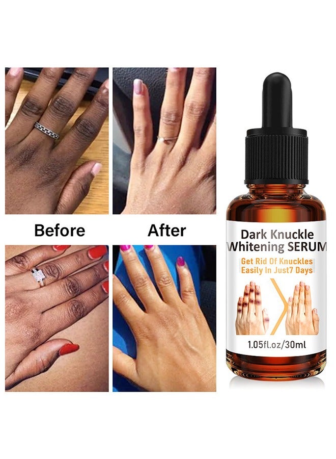 Dark Knuckle Whitening Serum - Skin Whitening Oil Brightening Dark Spots,Obvious Useu Effect，Get Rid of Knuckles Easily In Just 7 Days，Whitening Knee Melanin with Glow Essence,30 ml