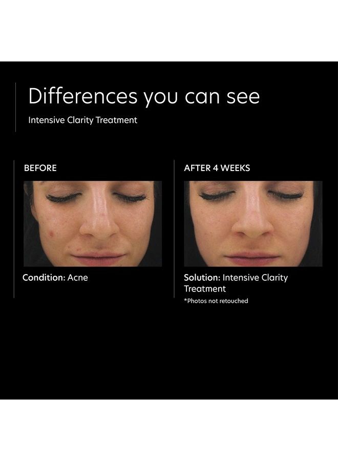 The Acne Control Skin Care Set (Kit Includes BPO Facial Cleanser, Niacinamide Face Cream, Salicylic Acid Acne Gel, Retinol Treatment)
