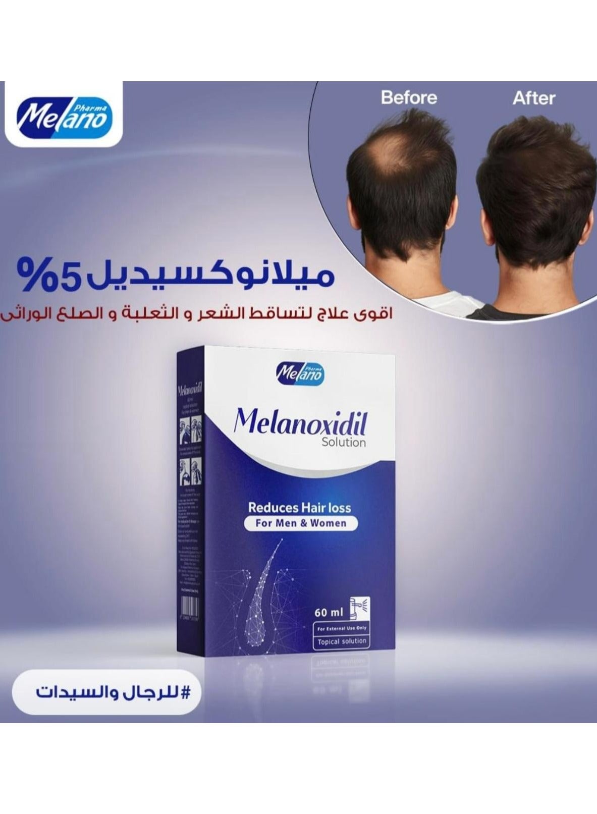 Melanoxidil 5% topical solution 60 ML