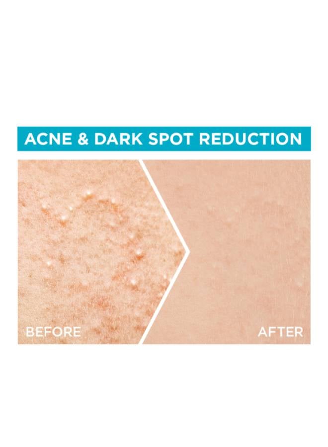 Skinactive Fast Clear Booster Face Serum For Acne Prone Skin With Salicylic Acid, 30ml - image 3