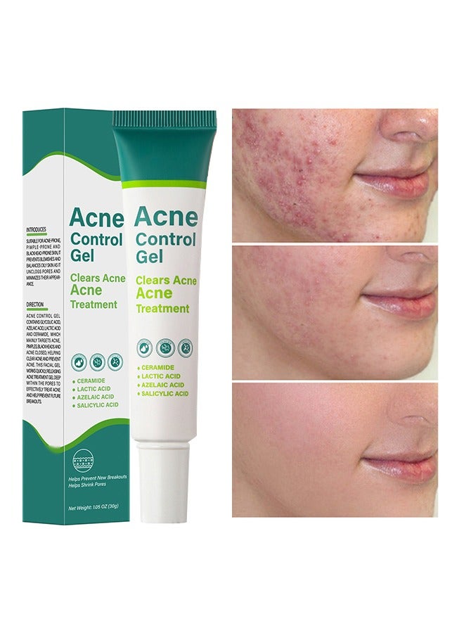 Acne Control Gel，Clears Acne, Acne Treatment Cream,Acne Spot Treatment gel,Clear Acne Spot Treatment Gel,Pimple Cream for Acne Prone Skin Care,Acne Control Gel,Salicylic Acid Acne Treatment Gel,Clear Breakouts, 30g