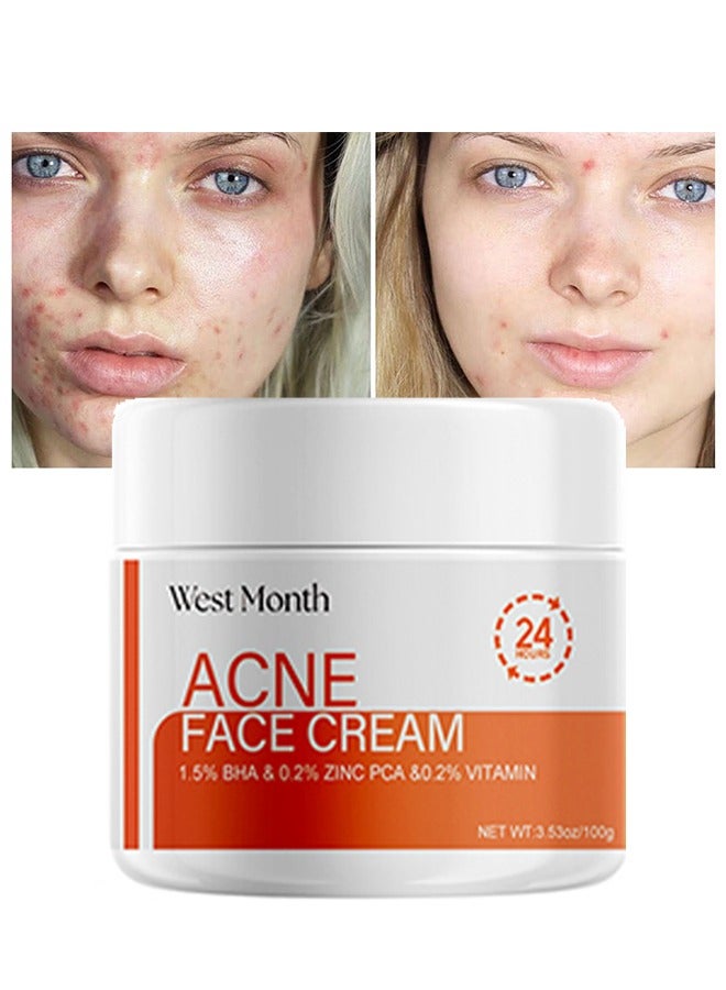 Acne Face Cream, Acne Spot Treatment for Face & Acne Dots, Natural Cystic Acne Treatment, For All Skin Types, Premium Acne Scar Cream & Pimple Remover 100g
