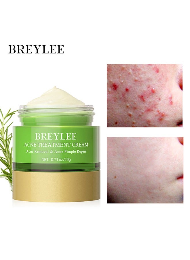 Acne Treatment Cream, Acne Removal Acne Pimple Repair Cream, Natural Cystic Acne Treatment, Premium Acne Scar Cream And Pimple Remover, 20G