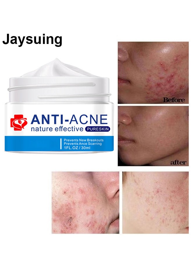 Acne Treatment Face Cream, Acne Spot Treatment for Face and Acne Dots, Natural Cystic Acne Treatment, For All Skin Types, Premium Acne Scar Cream and Pimple Remover, 30ML