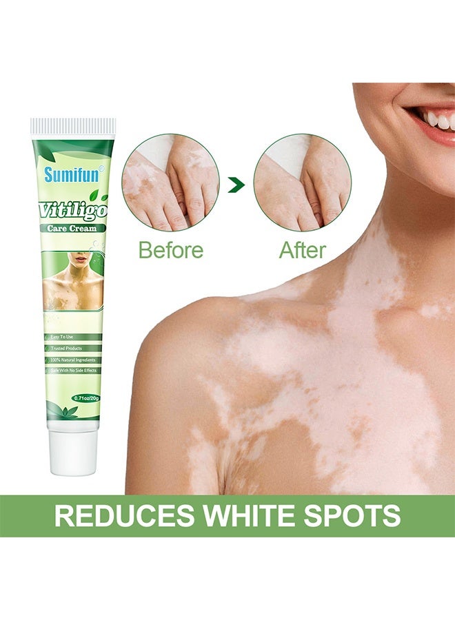 Vitiligo Care Cream, Vitiligo Cream, Natural Effective Vitiligo Treatment for All Skin Type, Reduce White Spots, Improve Skin Pigmentation 20g