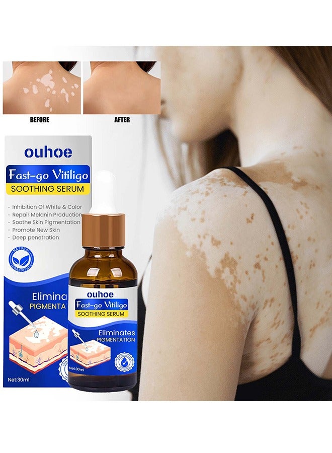 Fast-go Vitiligo Soothing Serum - White Tag Treatment Vitiligo Therapeutic Serum Universal White Spot Cleansing Serum-30ml