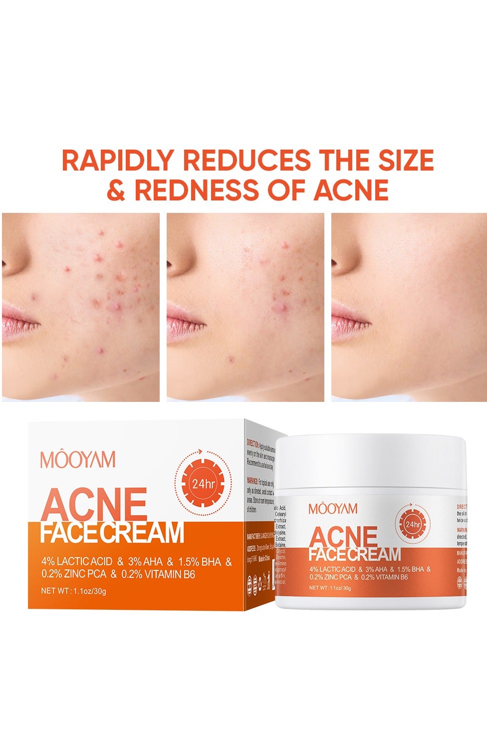 Acne Treatment for Face for Hormonal Cystic Stubborn Acne Cream for Sensitive Skin Teens Adults 30g