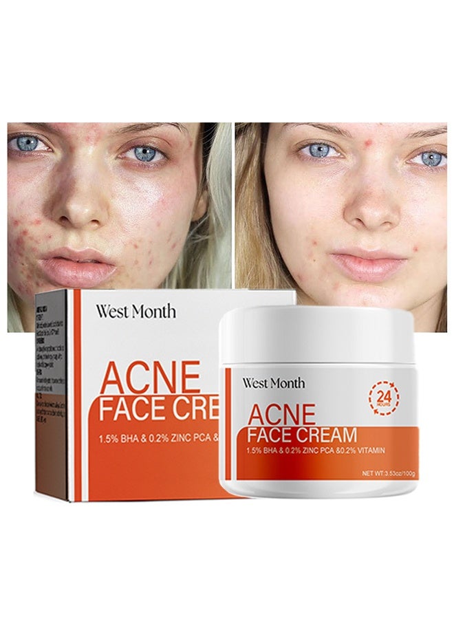Acne Face Cream, Acne Spot Treatment for Face & Acne Dots, Natural Cystic Acne Treatment, For All Skin Types, Premium Acne Scar Cream & Pimple Remover 100g