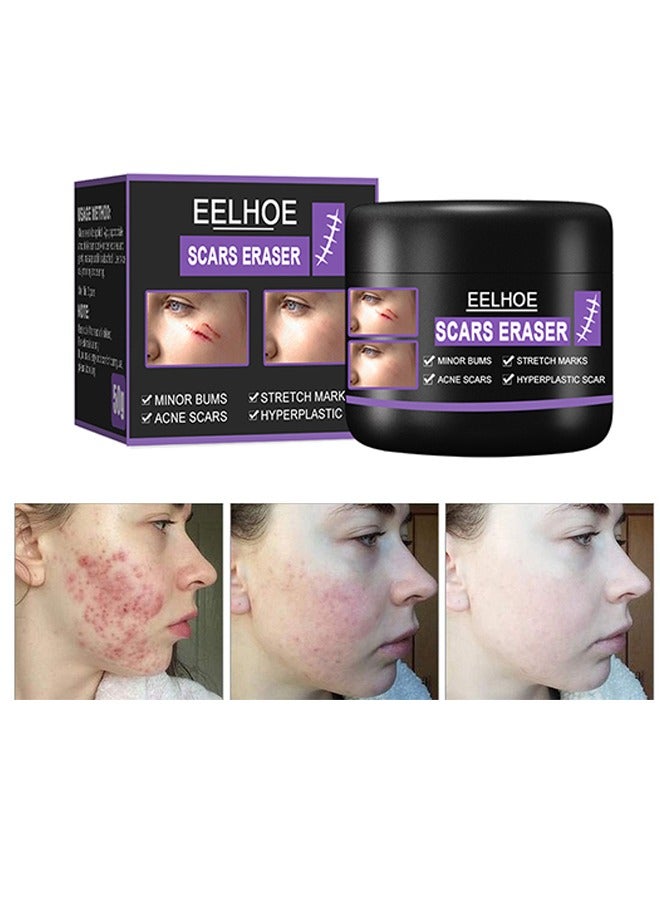 Scar Eraser，Scar Removal Cream，Acne Scar Treatment，Deep Acne Scar Removal， Burns Keloids Hypertrophic， Repair Damaged Skin，Removing Acne Marks Scar Repair Cream ﻿50g