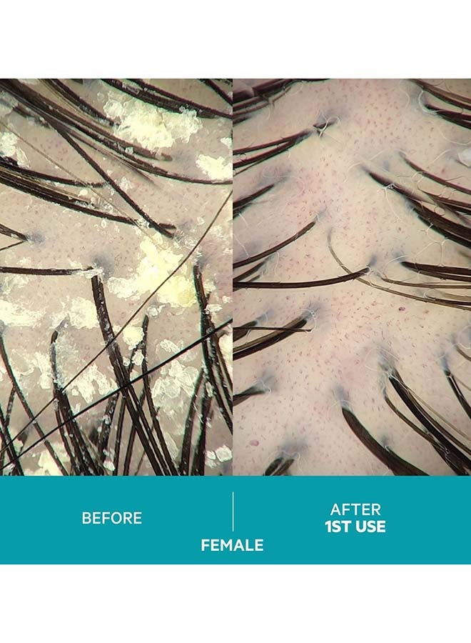 Dandrene Exfoliating Anti-dandruff Shampoo - for Flaky, Itchy Scalp, Exfoliating Shampoo for Dry Scalp, Seborrheic Dermatitis & Scalp Psoriasis, Color Safe, Sulfate Free, With Nanosome Technology 205ml - image 6