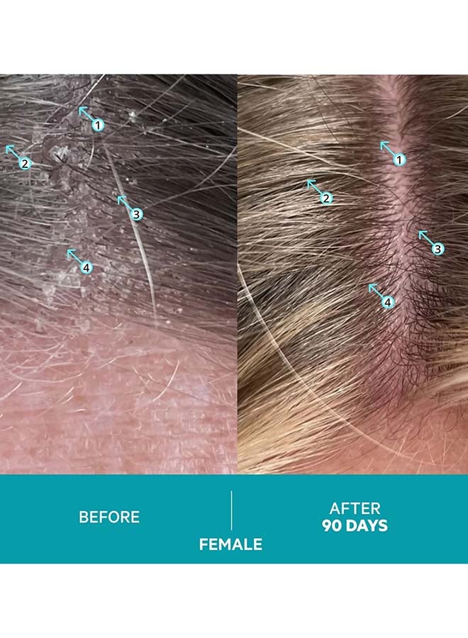 Dandrene Exfoliating Anti-dandruff Shampoo - for Flaky, Itchy Scalp, Exfoliating Shampoo for Dry Scalp, Seborrheic Dermatitis & Scalp Psoriasis, Color Safe, Sulfate Free, With Nanosome Technology 205ml - image 7