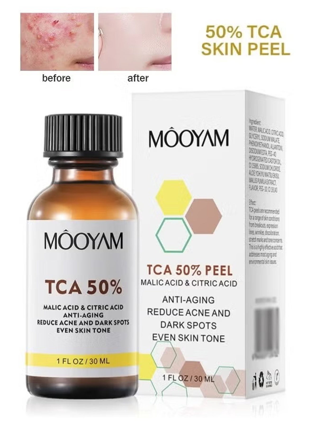 TCA 50% Peel Solution, With Malic Acid & Citric Acid Peeling Serum, Ultimate Chemical Exfolianting Facial Peel for Dark Skin, Dark Spots, Acne, Wrinkle, 30ML