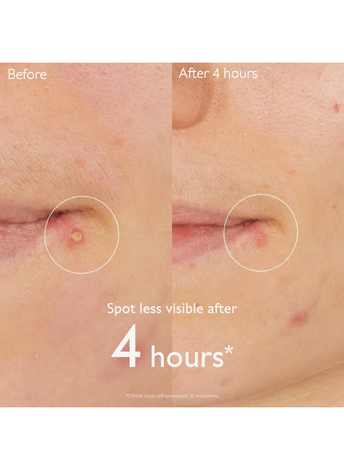 Vinopure Salicylic Spot Solution - 15 mL - image 3