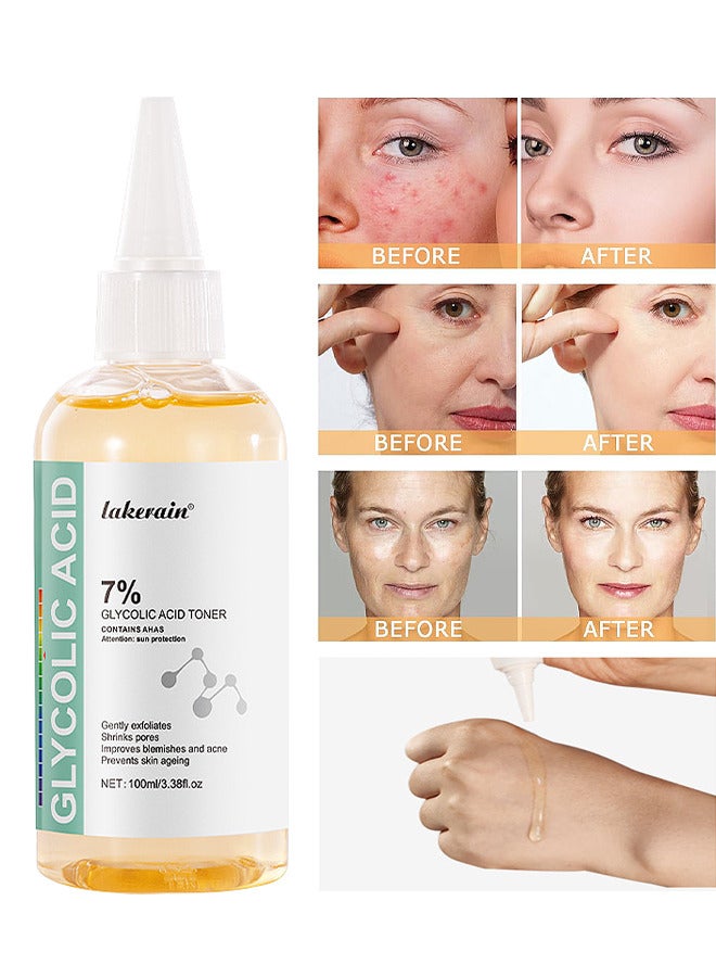 7% Glycolic Acid Toner, Removing Acne, Reducing Acne Marks, Removing Closed Mouth Acne, And Repairing The Skin, Exfoliating Serum For Face, Hydrates And Reduces Skin Blemishes, 100ML