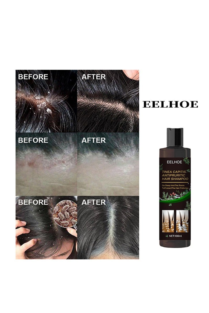 Tinea Capitis Antipruritic Hair Shampoo- Deep Clean Safe Gentle Effective Professional Anti-Dandruff Remove Mites and Relieve Itching Natural Extract Anti Hair Loss 100ml