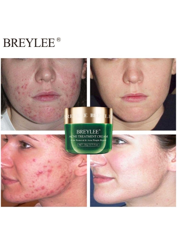 Acne Treatment Cream, Tea Tree Oil Acne Cream for Clearing Severe Acne, Breakout, Remove Pimple and Repair Skin 20g