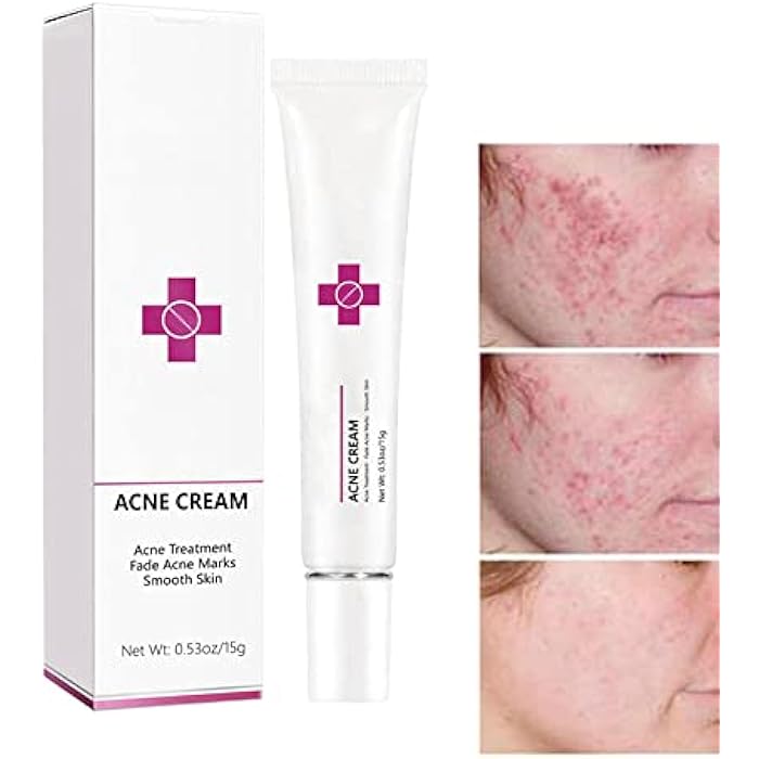 Acne Cream Pimple Cream for Face, Oil Control Pimple Remover Cream Get Rid of Pimples Fast,for Oily and Acne Prone Skin, Cruelty Free, Crema para espinillas en la cara