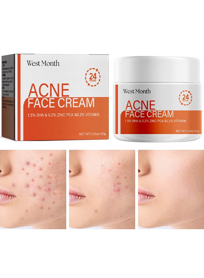 Acne Face Cream, Acne Spot Treatment For Face And Acne Dots, Natural Cystic Acne Treatment, Acne Moisturizer, Premium Acne Scar Cream And Pimple Remover 100G