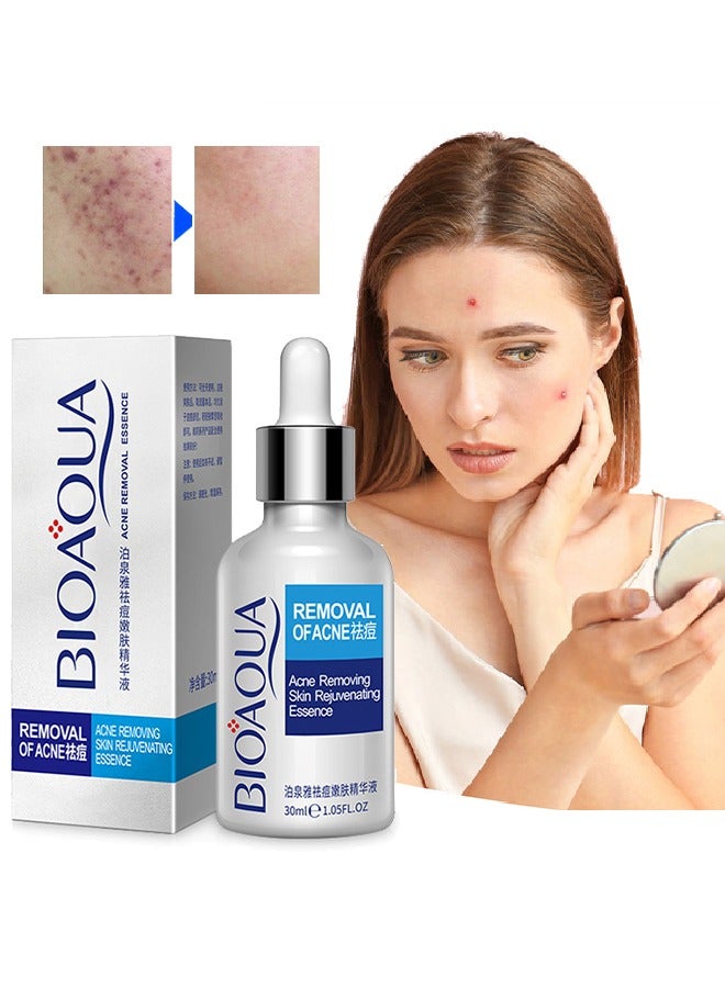 Acne Removal Essence, Brightening Treatment Serum,Face Serum for Sensitive Skin and Acne 30ml