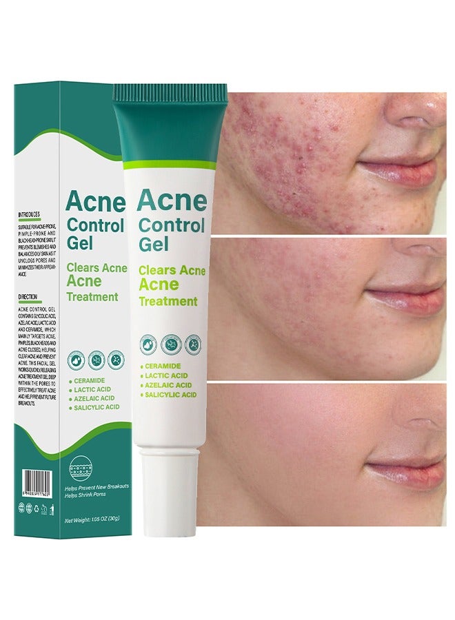 Acne Control Gel - Acne Treatment Cream,Acne Spot Treatment gel,Clear Acne Spot Treatment Gel,Pimple Cream for Acne Prone Skin Care,Salicylic Acid Acne Treatment Gel,Clear Breakouts, 30g