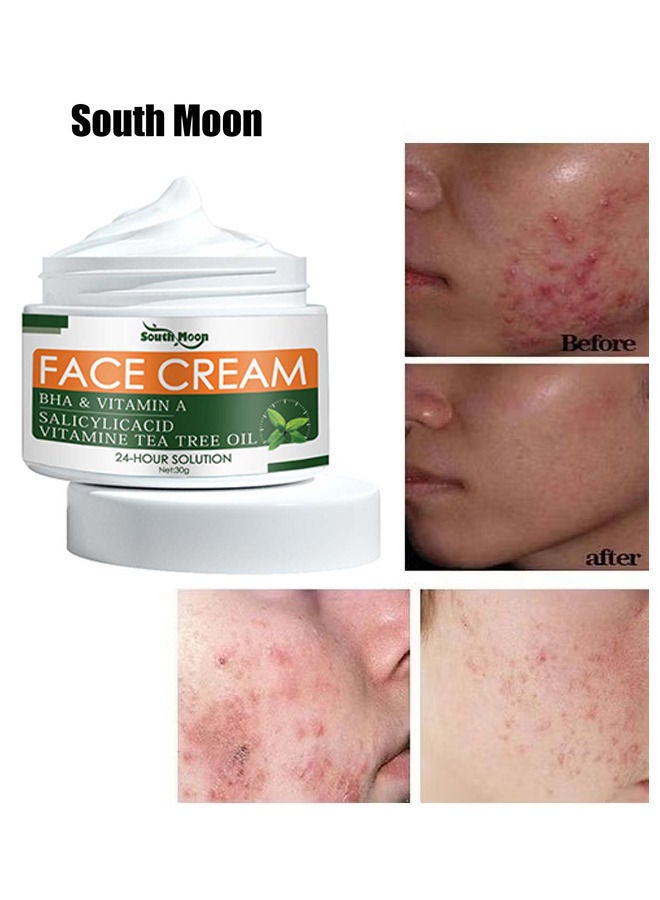 Acne Treatment Face Cream Acne Spot Treatment For Face And Acne Dots Natural Cystic Acne Treatment For All Skin Types Premium Acne Scar Cream And Pimple Remover 30ML